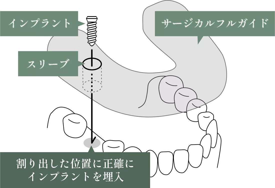 割り出した位置に正確にインプラントを埋入